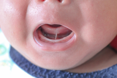 Close-up view of baby with tongue-tie (ankyloglossia)